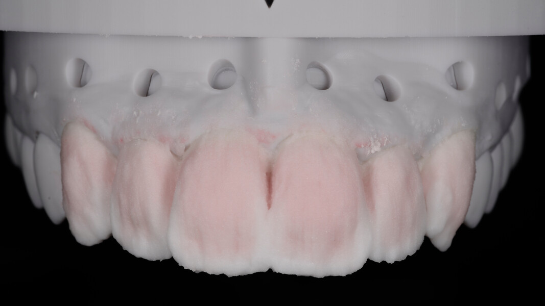 Fig. 16: Application of CERABIEN ZR Enamel in Shade E1 and CERABIEN ZR Luster in Shade LTX to create translucency at the incisal edge.