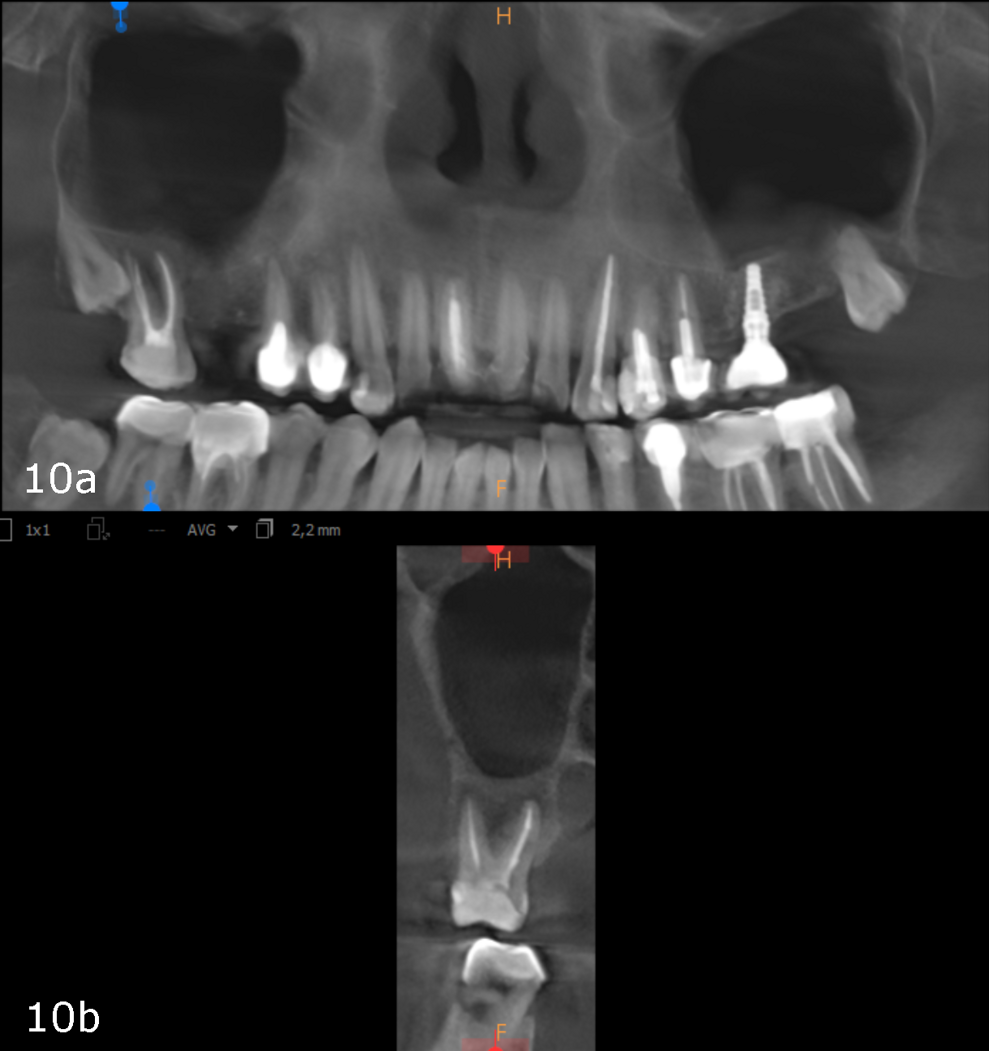 Figs. 10a & b: CBCT scan taken 12 weeks later showing complete healing, panoramic view (a) and cross-section of tooth #17 (b).