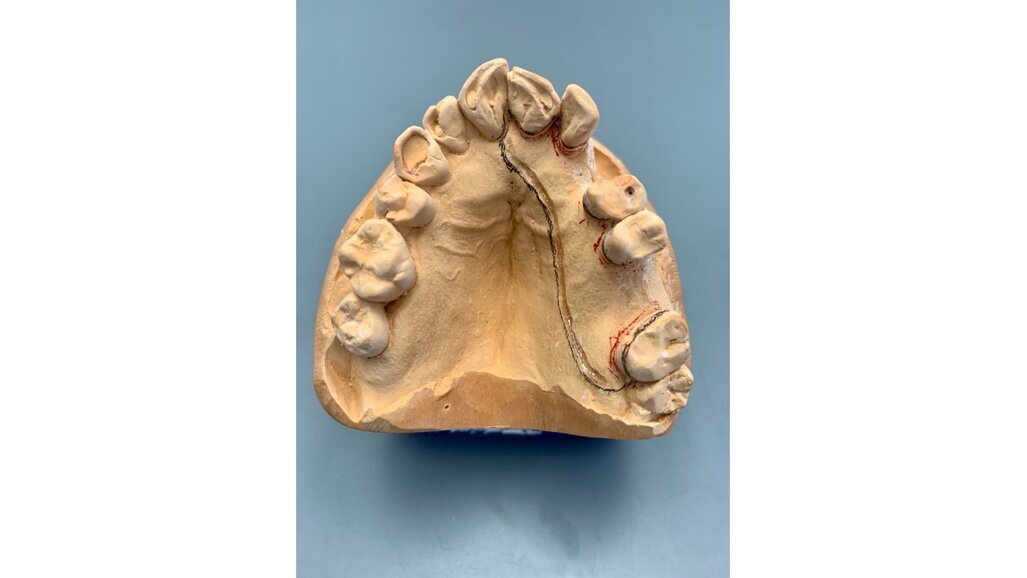 POM: een nieuwe speler op het terrein van uitneembare prothetische voorzieningen