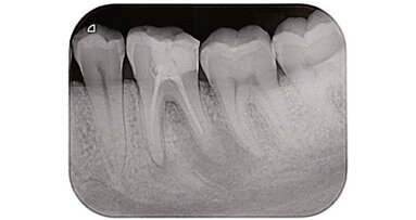 Un’innovativa sistematica per il ritrattamento ortogrado dei canali radicolari: Endo Re-Start (Komet)