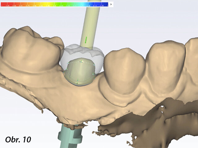 Návrh definitivní náhrady v softwaru Planmeca PlanCAD Premium.