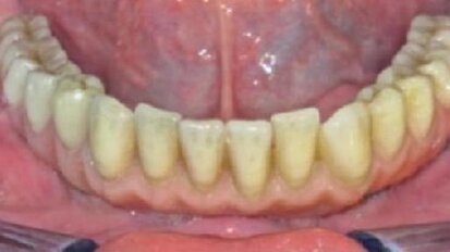 Stałe uzupełnienie protetyczne pełnego łuku zębowego, bez metalu, na czterech krótkich implantach