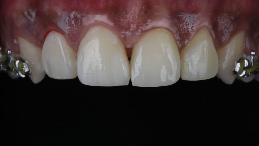 Fig 19: Final Post-op