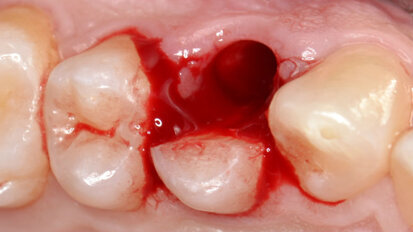 Riabilitazione di un sito monoedentulo con impianto postestrattivo a provvisorizzazione immediata