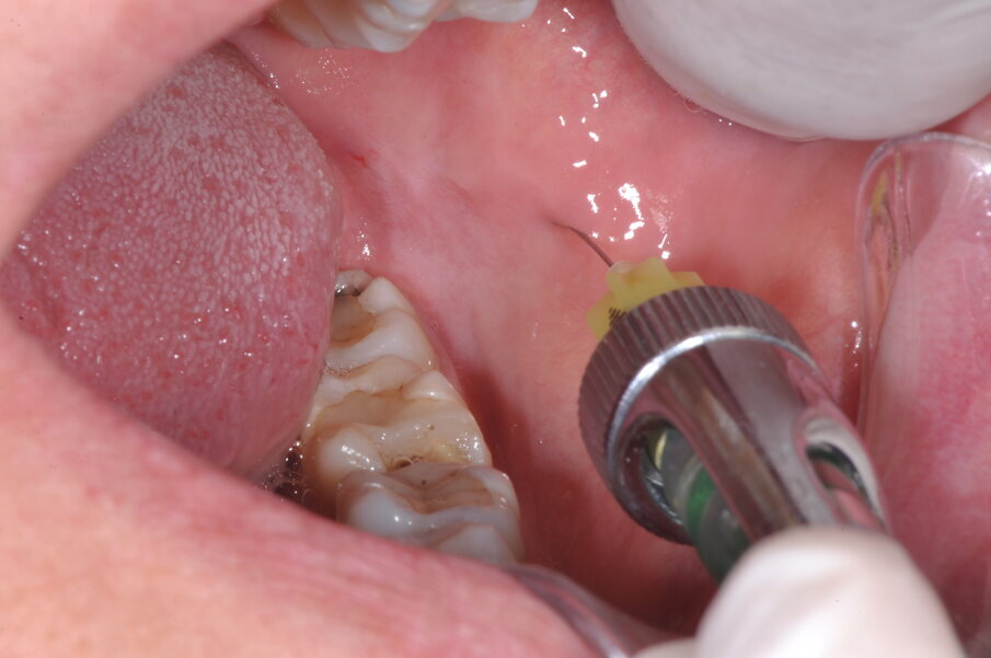 Fig. 2 - Anestesia del nervo buccale.