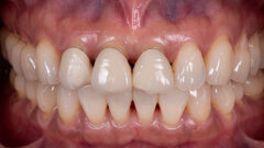 Meeting high functional and aesthetic demands with ceramic solutions