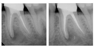 Removal of warm carrier-based products with the Twisted File