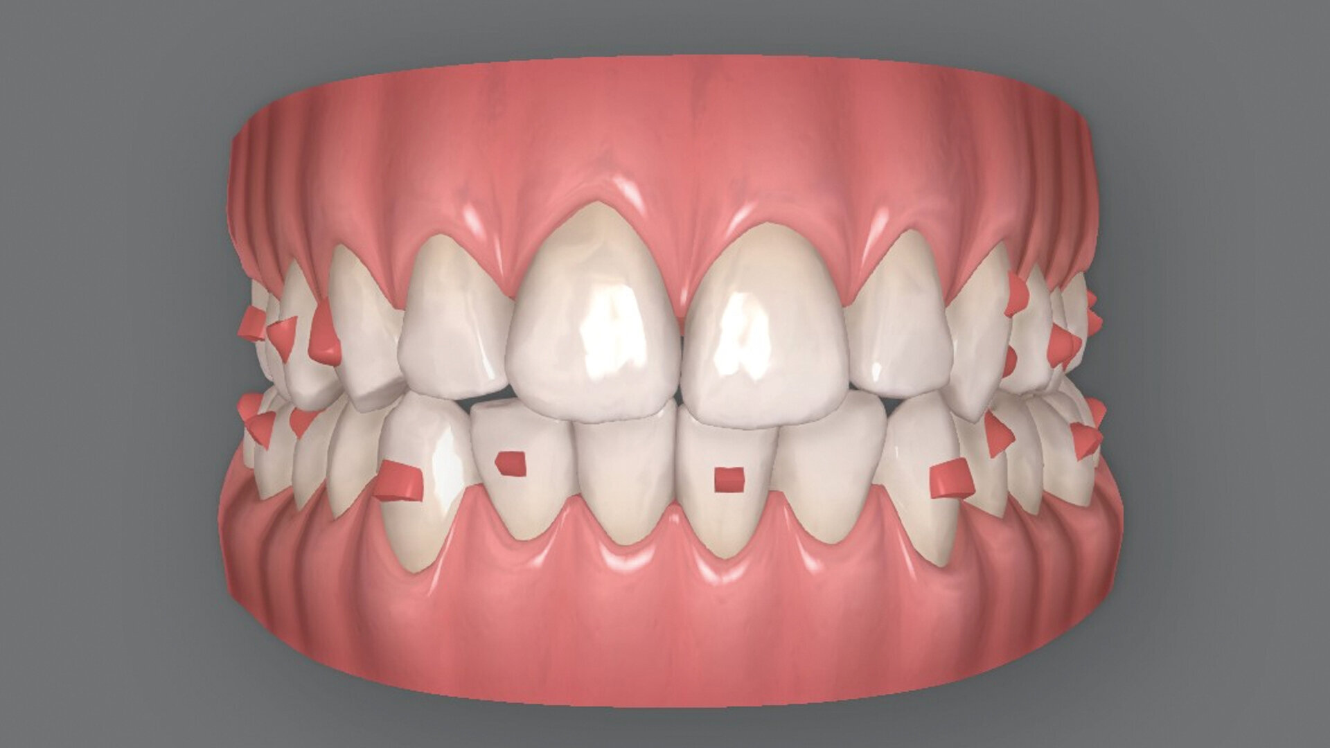 Traitement orthodontique par aligneurs transparents d’une malocclusion complexe