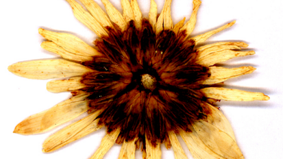 Legame tra infiammazione delle gengive e Alzheimer