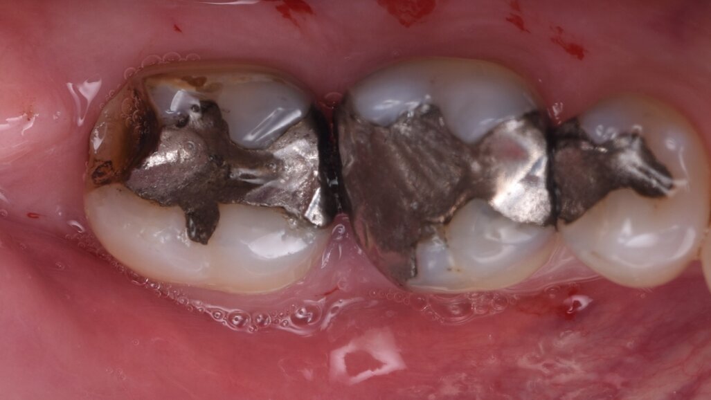 Immediate implant placement into two molar sockets