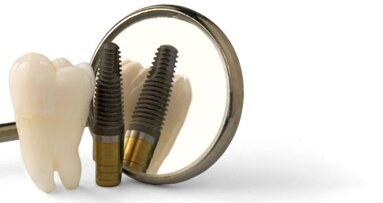 Cochrane-onderzoek: geen verschil in langetermijnsucces tussen implantaten