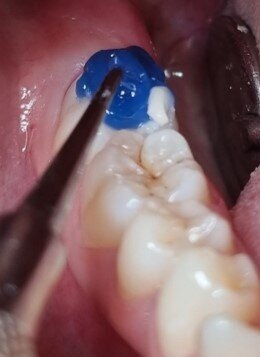 Fig. 5: The stamp was firmly pressed on to the cavity filled with EQUIA Forte HT when the material had reached a rubbery state.