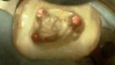 Nowatorska metoda wypełniania kanałów – technika dopasowanego pojedynczego ćwieka gutaperkowego z określonym stopniem rozbieżności