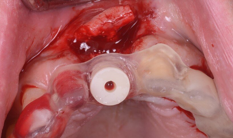 Fig. 16_Dima di preparazione per il passaggio della fresa pilota.