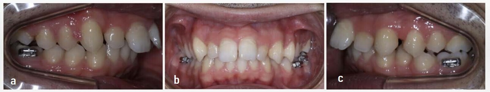 Figs. 11a–c: Class I molar overcorrection.
