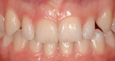 Bioestetica:  un nuovo approccio al miglioramento del sorriso