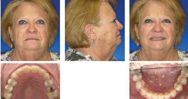 Case report: Advances in aligner treatment for open bites deliver stable correction