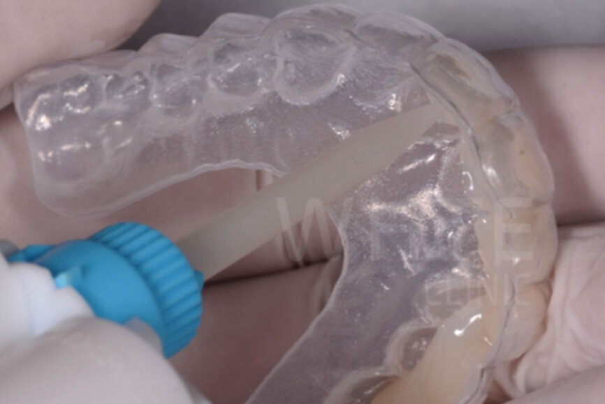 Fig. 6: Motivational mock-up made of bis-acryl (Structur 3).