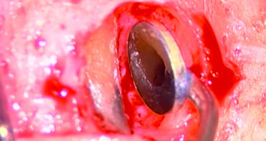 La terapia clinica e chirurgica delle perforazioni iatrogene