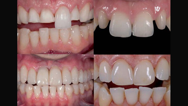 Indicaciones para la selección de cerámicas