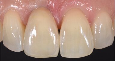 Digital dental shade measurement: Practical applications with a state-of-the-art colorimeter Digital dental shade measurement: Practical applications with a state-of-the-art colorimeter