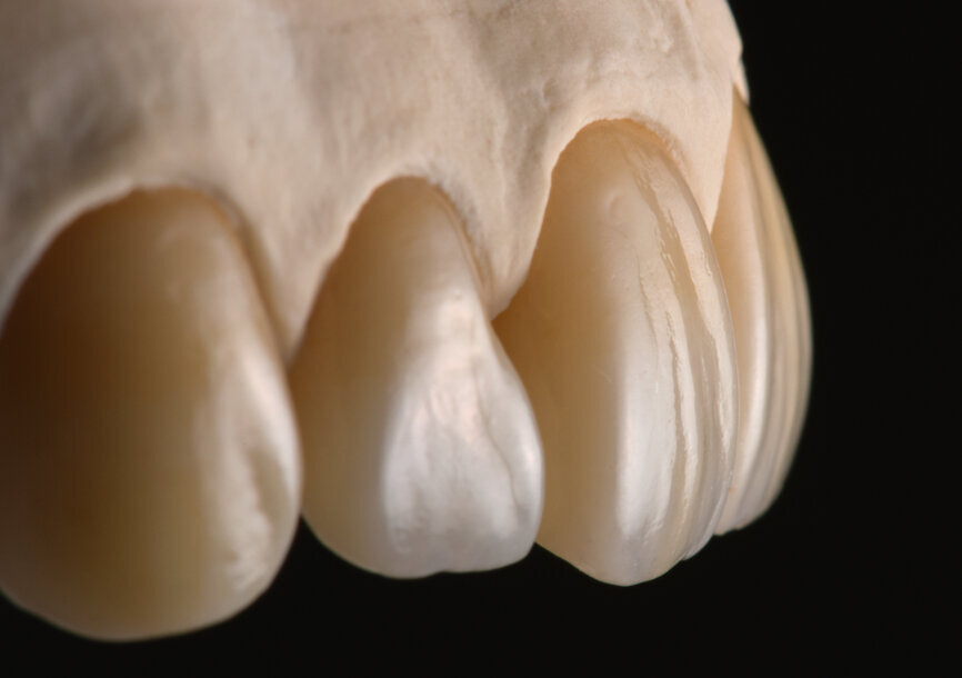 Zolid Gen-X wurde 2020 auf den Markt gebracht. Dank seiner hervorragenden Materialeigenschaften ist es ein Material für alle Indikationen. © Atsushi Hasegawa/Organ Dental Lab