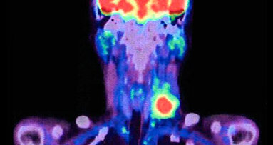 Tilmanocept: progresso significativo nella riduzione di complicanze chirurgiche nei tumori di testa e collo