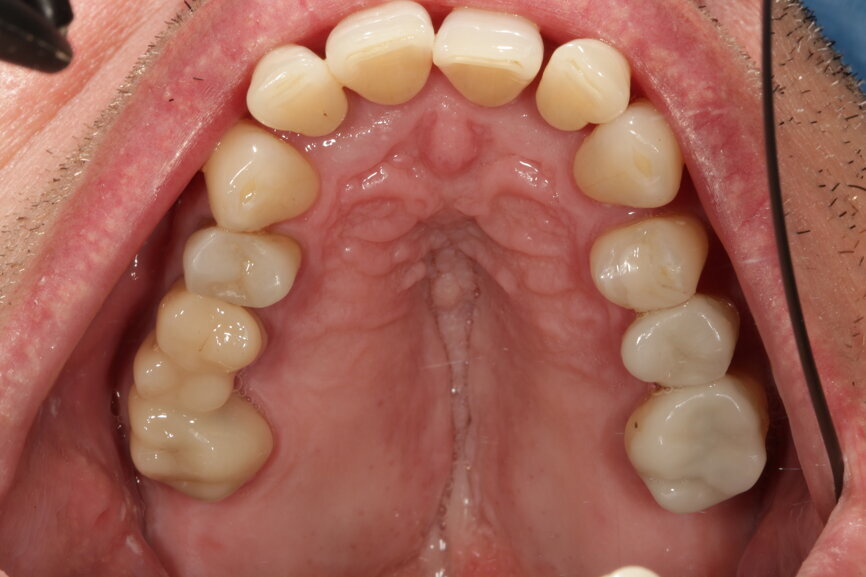 Fig. 10b: Occlusal view after the treatment: glass-ceramic crowns (a), composite fillings and a bridge of lithium disilicate (b).