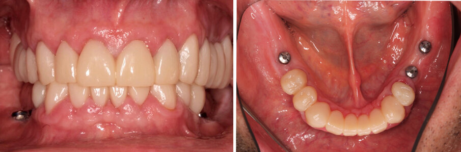 Figs 14A-B: Upper and lower jaw with the long-term temporaries in place