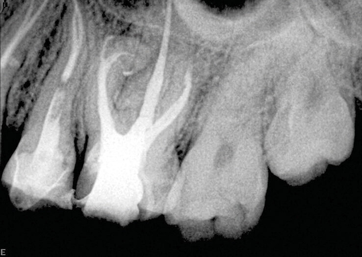 Slučaj 3 – Slika br. 10: Periapikalni kontrolni Rtg snimak nakon godinu dana od tretmana