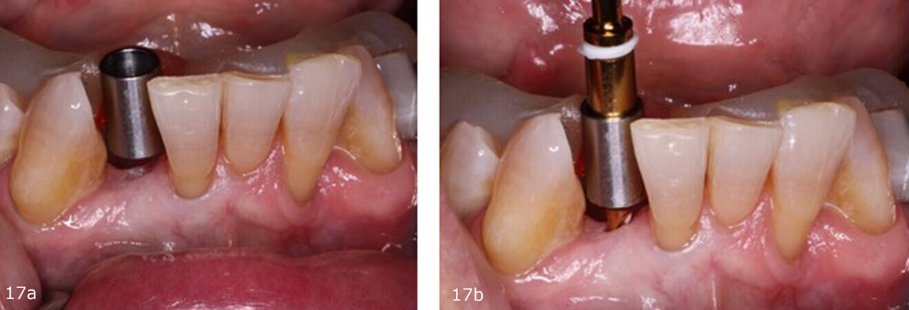 Figs. 17a & b: Corrected surgical guide inserted intra-orally (a) and utilised to guide the osteotomy drills for site preparation (b).