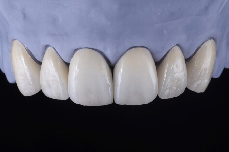 Obr. 14a,  b: Finální náhrady.