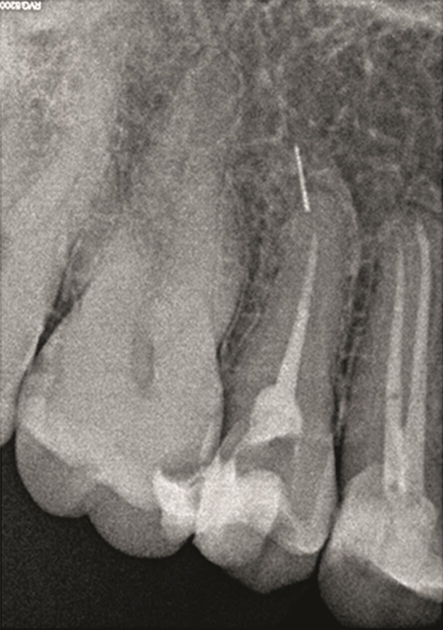 Fig. 2a–c: Pre-op radiograph (a) …