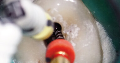 Endodontické ošetření – případová studie