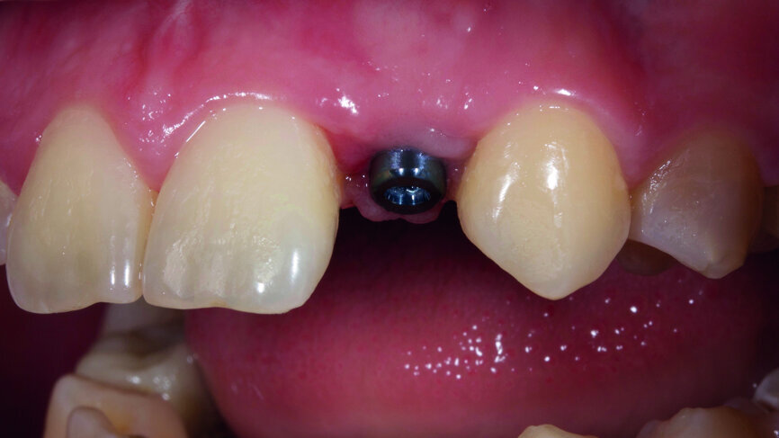 Fig. 7: Successful placement of the implant.