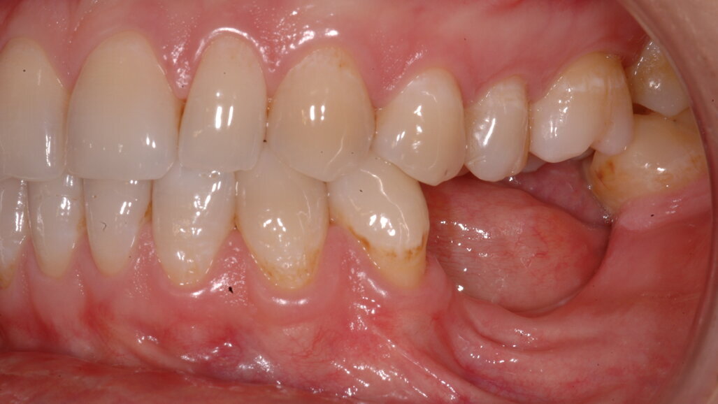 Soluzione di una grave atrofia ossea, orizzontale e verticale, con tecnica della lamina corticale