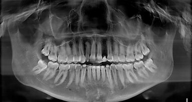 Gestione multidisciplinare di paziente con agenesia