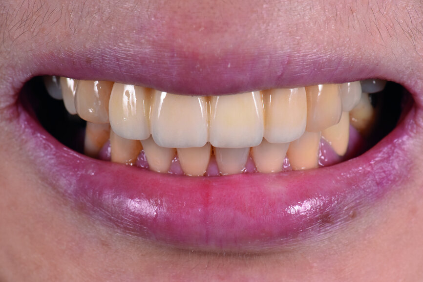 Fig. 49: Patient smiling two weeks after delivery of the final restoration.