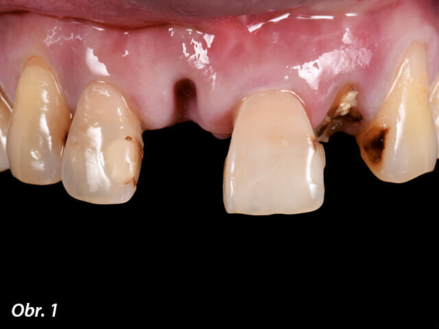 Obr. 1: Předoperační situace předních zubů z frontálního pohledu