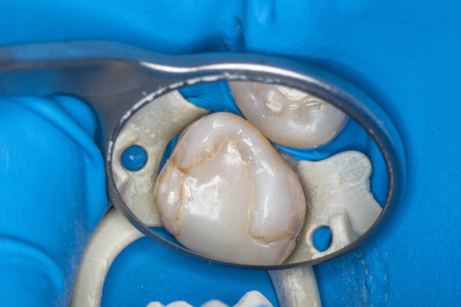 Fig. 11: The maxillary second molar before treatment.