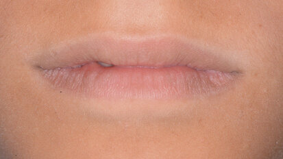 La terapia di mantenimento e l’approccio clinico D-BIOTECH: case report