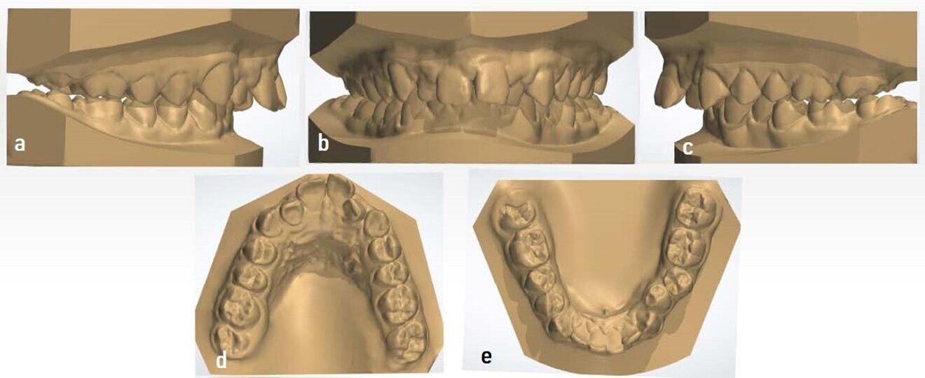 Figs. 8a–e: Initial digital models showing a bilateral Class II malocclusion and an overjet of 11 mm (images generated using 3Shape Dental System).