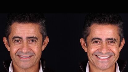 Colocación de restauraciones cerámicas adhesivas en la zona estética (2)