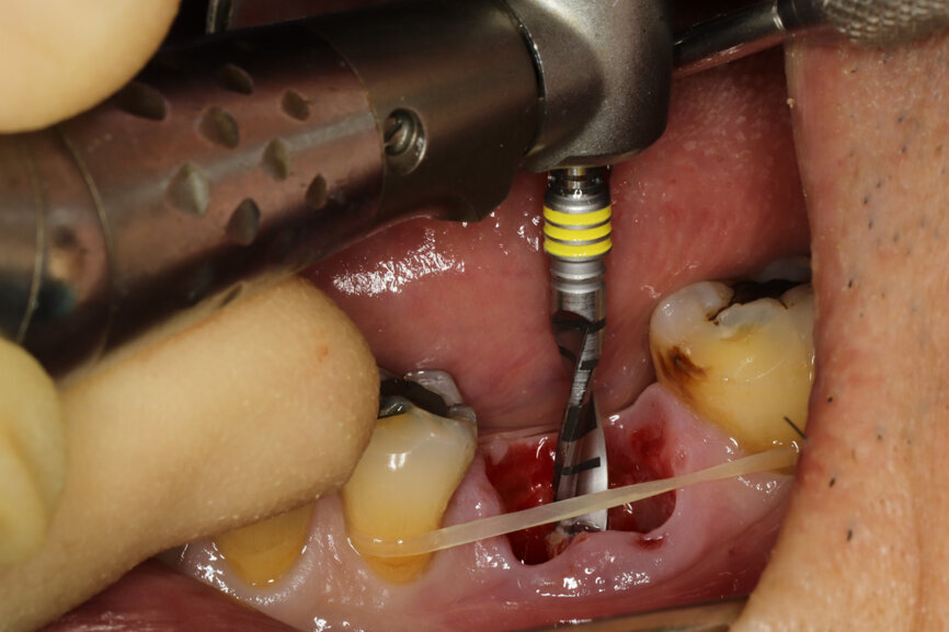 Fig. 10: Osteotomy with the ⌀ 2.8 mm drill.