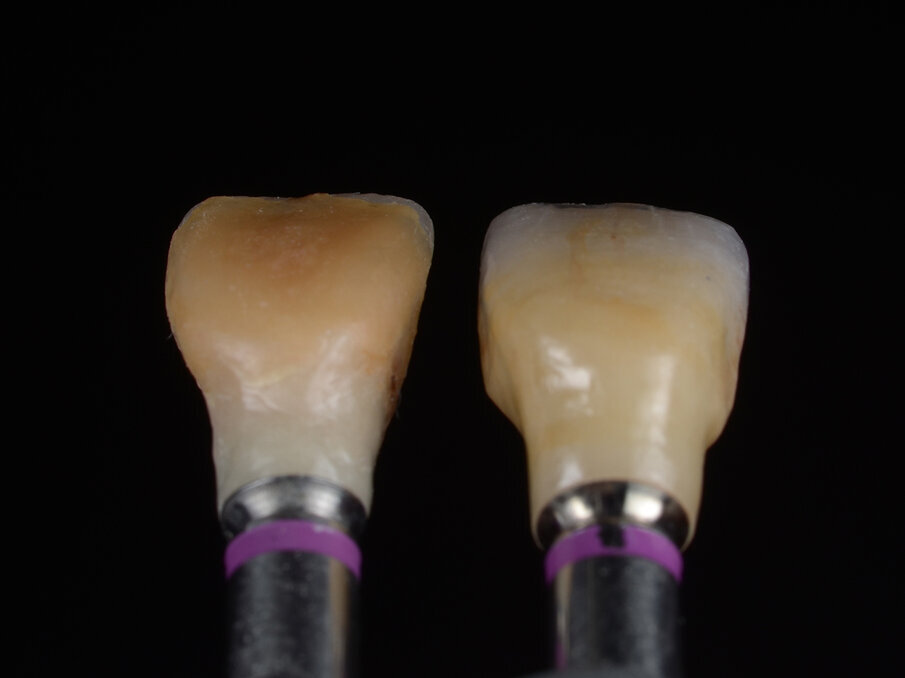 Fig. 10 - Valutazione post-operatoria: confronto tra corona provvisoria in resina e corona definitiva in ceramica.