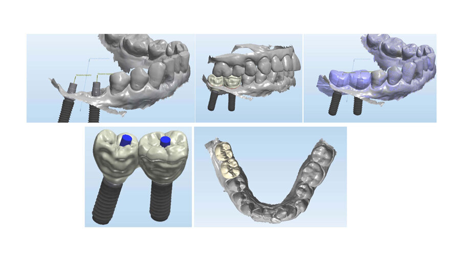 Fig. 17_Workflow in laboratorio (Odt. Alessandro Giacometti): dopo acquisizione delle impronte digitali intraorali, queste vengono importate nel software CAD Dental Design (3Shape). La scansione delle forme dei provvisori funzionalizzati permette di usarli per sviluppare le forme anatomiche del nostro futuro restauro. La scelta, dal portfolio del software, delle componenti protesiche adeguate per profilo d’emergenza protesico, profondità del tunnel mucoso e ritenzione protesica consente di completare il wax-up anatomico. Successivamente, sempre digitalmente, il “cut-back” vestibolare permette di calcolare lo spazio adeguato per la stratificazione successiva. I manufatti protesici sono pronti per essere esportati tramite un file .Stl e inviati all’unità fresante CAM dove vengono trasformati in zirconio per essere finalizzati.