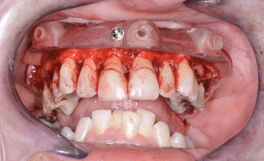 Fig. 7: Maxillary bone levelling foundation guide.