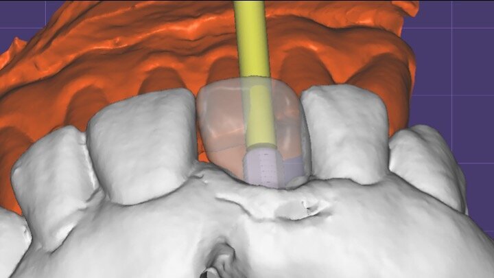 Figura 19. Diseño de la corona por CAD/CAM.