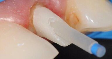 Wkłady koronowo-korzeniowe a ostateczny efekt estetycznego leczenia protetycznego