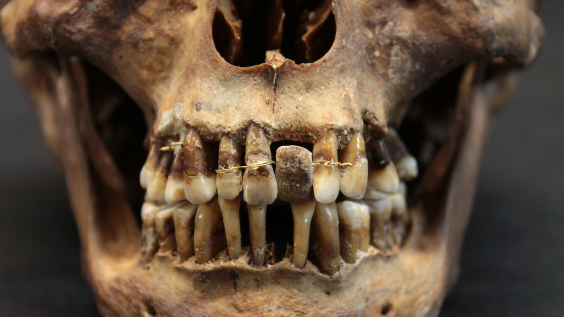 La dentition de la dépouille d'Anne d'Alègre livre ses secrets grâce au Cone Beam